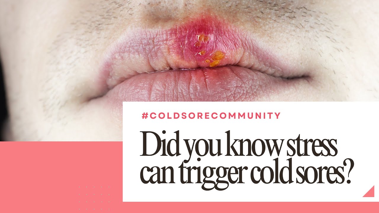 Did you know stress can trigger cold sores?