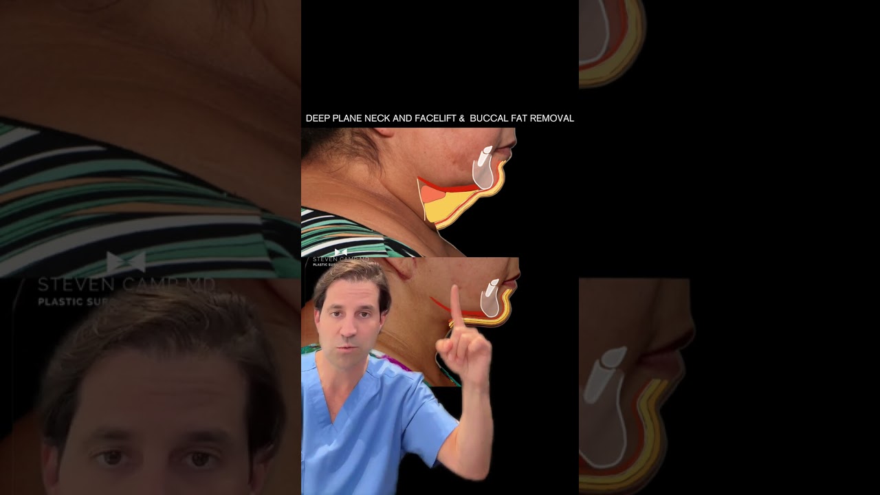 Dr. Camp Explains the Deep Plane Neck Lift