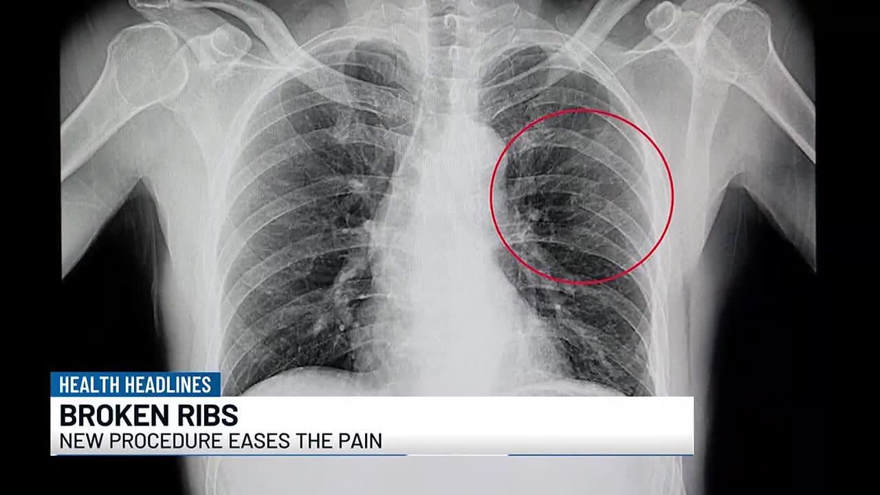 Health Headlines: Easing the pain of broken ribs