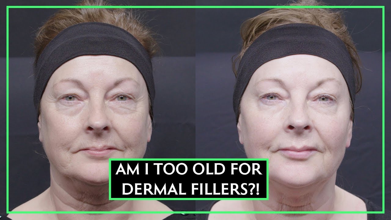 Can You Be Too Old For Dermal Fillers?