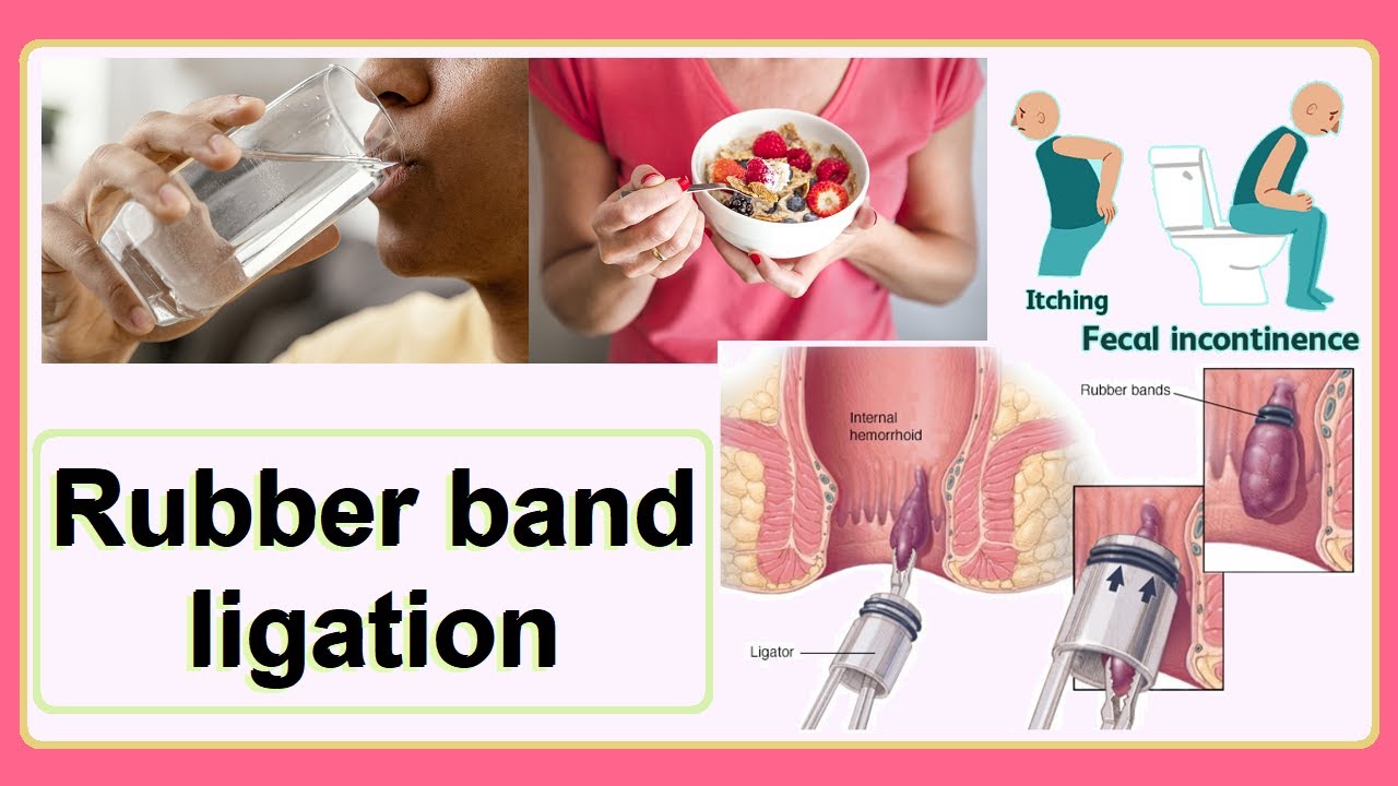 rubber band ligation