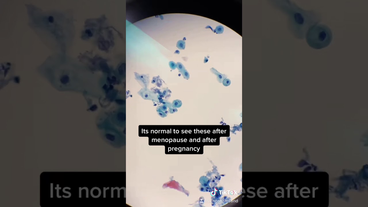 What parabasal cells look like on a normal Pap smear