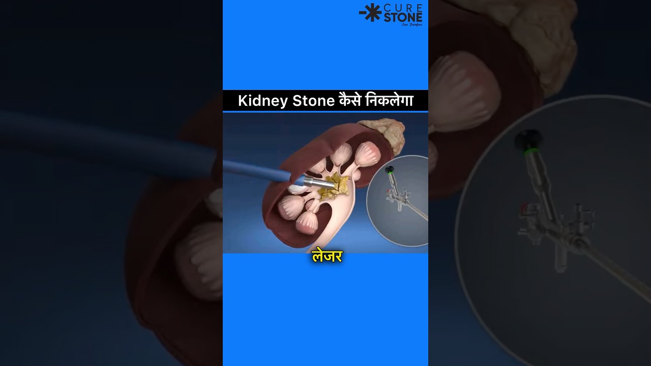 Kidney stones treatment | PCNL | Kidney stone laser removal | rirs | How pcnl is done