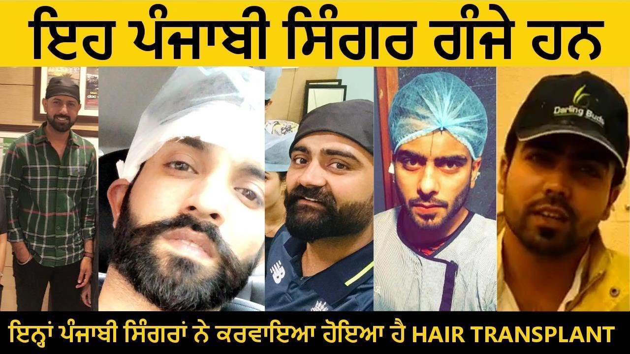 Top Punjabi Singers Who Did Hair Transplant Surgery