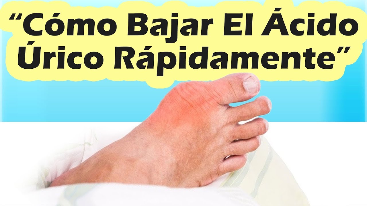 COMO BAJAR EL ACIDO URICO RAPIDO: Como Quitar El Dolor Dela Gota Rapido Con Estos Remedios Caseros