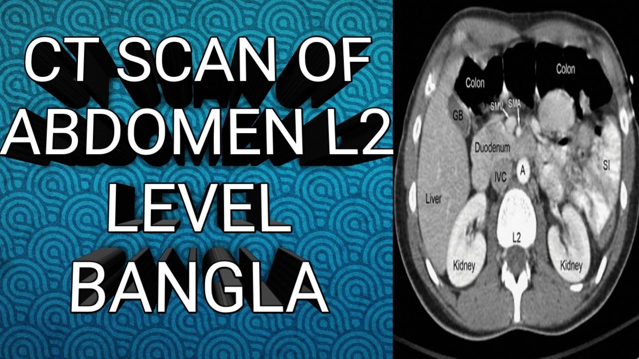 CT Scan Of Abdomen L2 Level _Bangla  |Radiology| |Anatomy| #anatomy #mbbs #viva