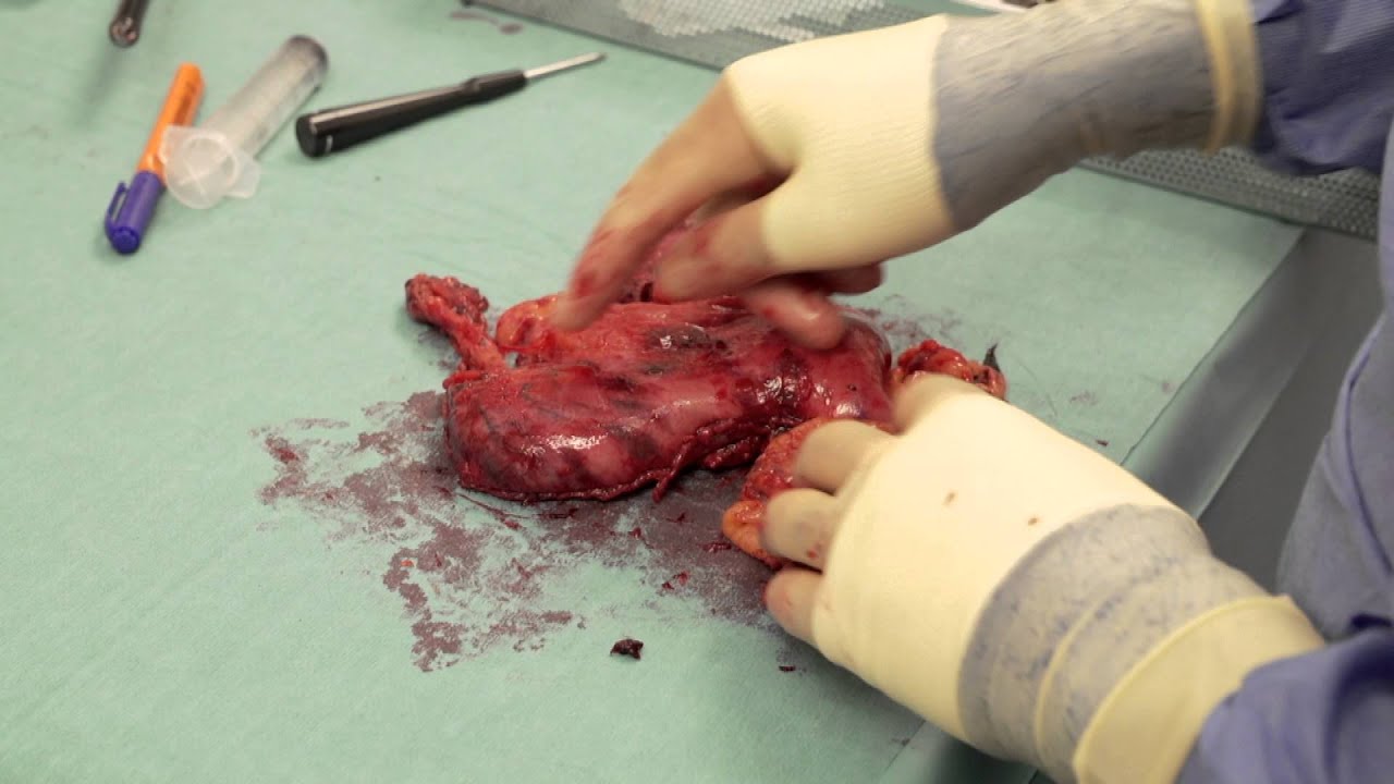 Diagnose Kanker, aflevering 6 / Catharina Kanker Instituut
