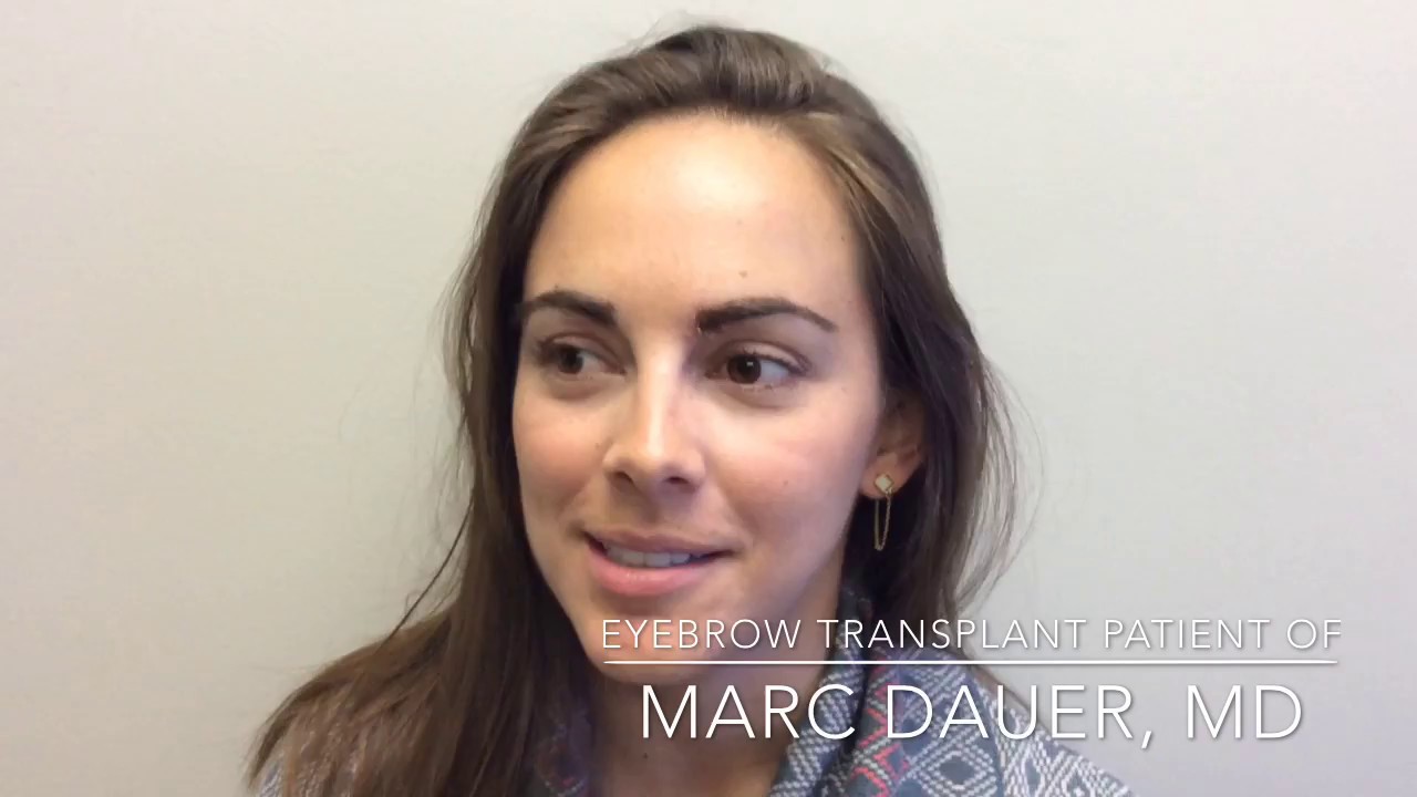 Eyebrow Transplant Testimonial- Maria Elisa Camargo