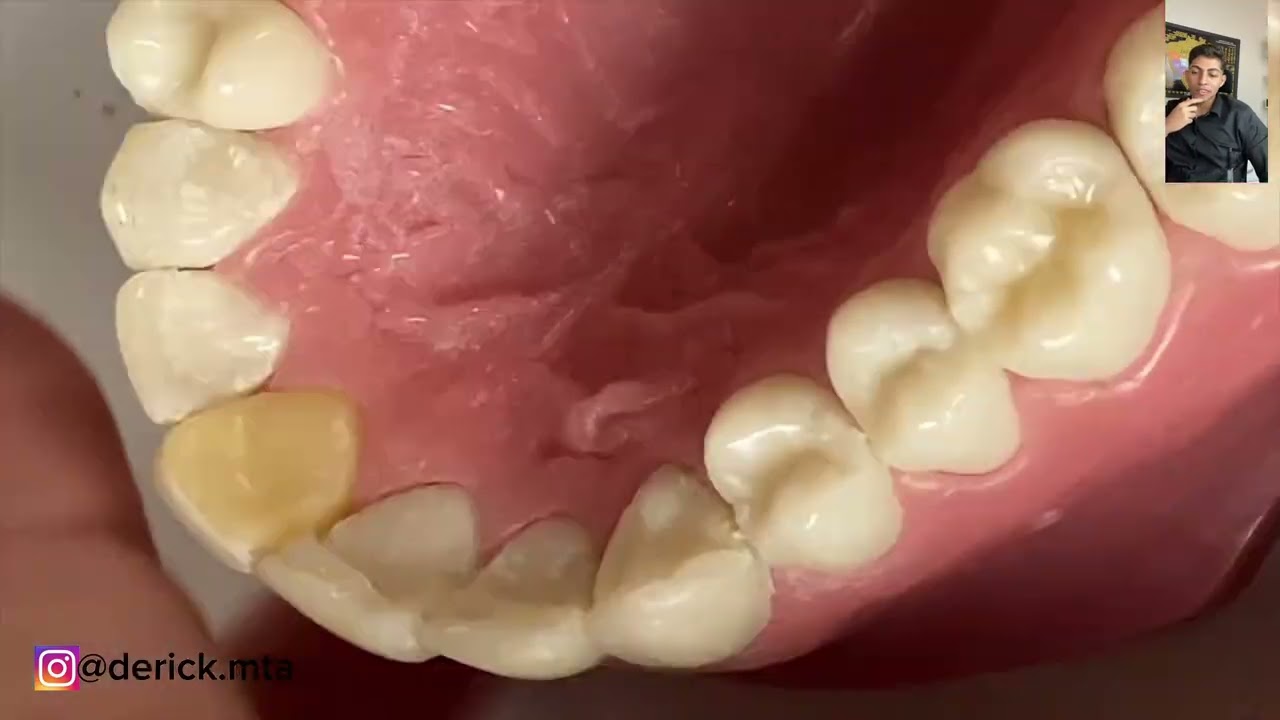 Restauração em resina dente 16| 26 anatomia principal/secundário