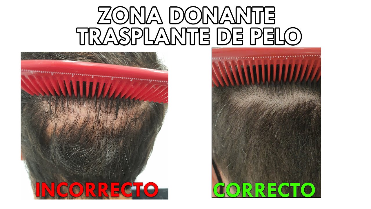 ¿Te vas a injertar pelo? Aprende esto sobre tu zona donante