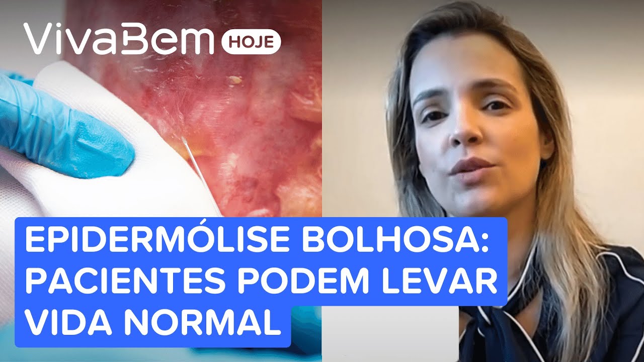 Epidermólise bolhosa: menino Gui, que comoveu a web, pode levar vida normal, é só proteger a pele