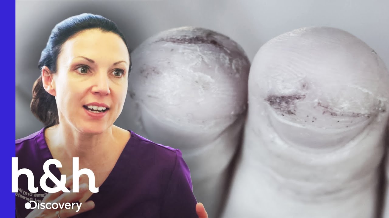 Sufre de eccemas y tiene dolorosas heridas en sus dedos | Clínica de la Piel | Discovery H&H