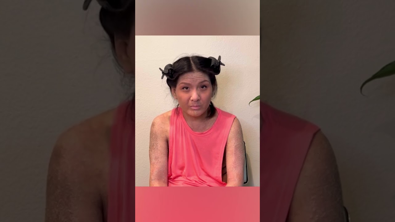 Living with Eczema: It's a Disability