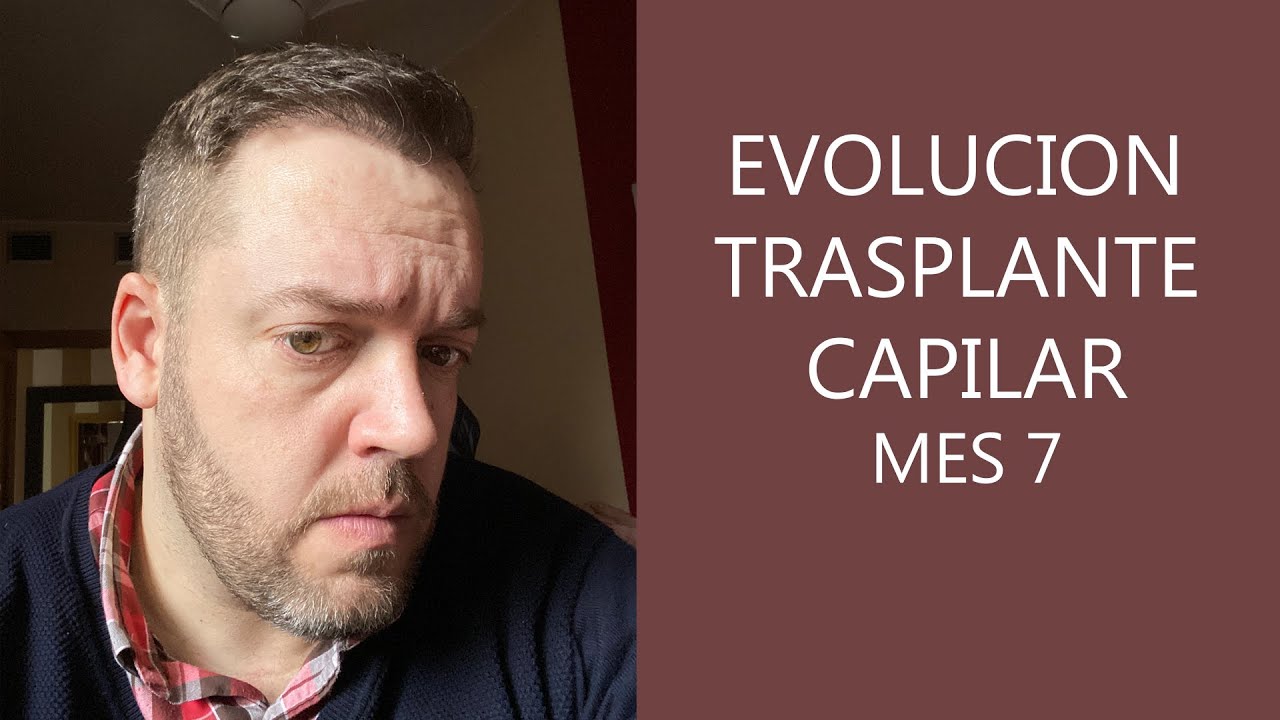 Evolución Trasplante capilar en Turquía - 7 meses