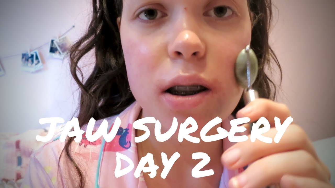 DOUBLE JAW SURGERY | Day 2