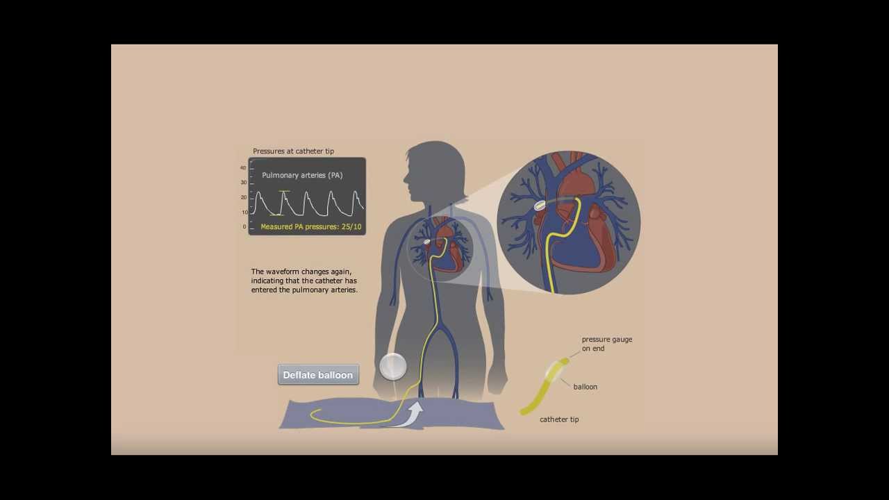 Right Heart Catheterization