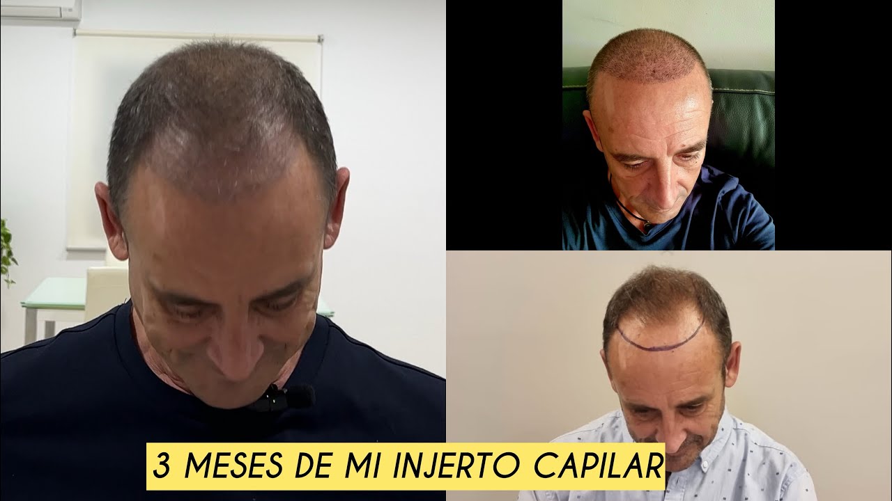 3 MESES DE MI INJERTO CAPILAR