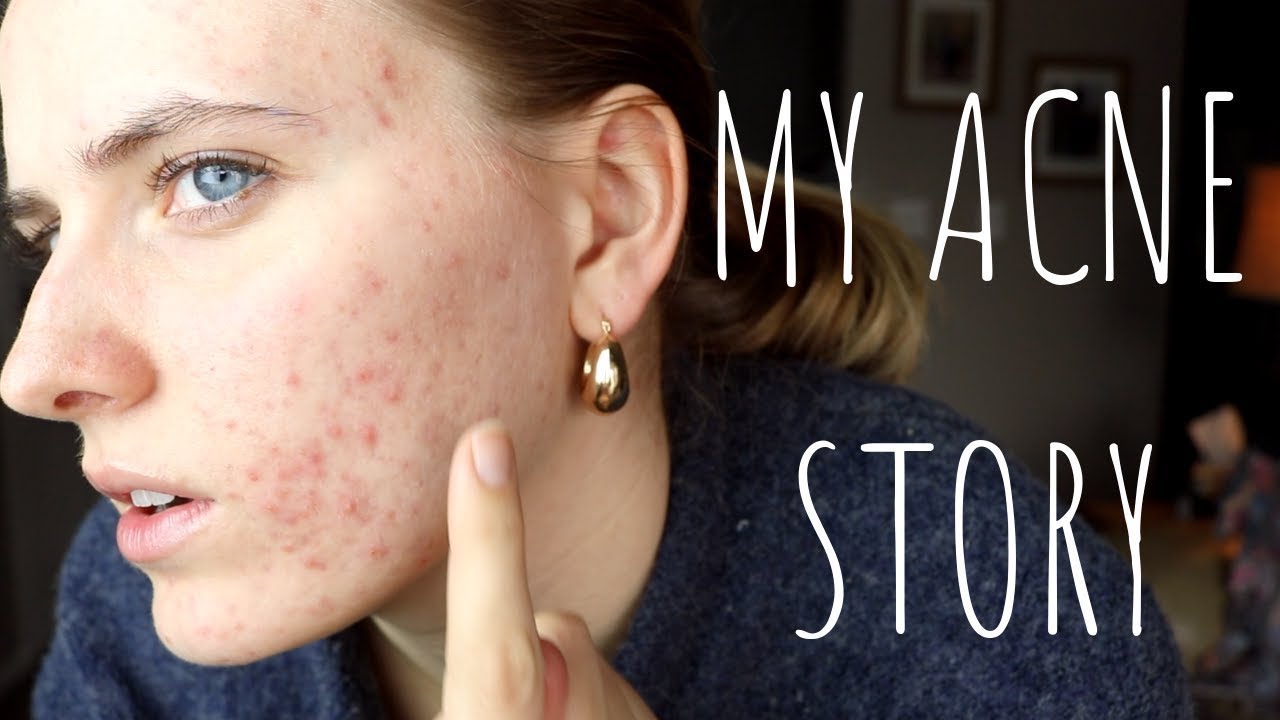 Living with Adult Acne || My Acne Story