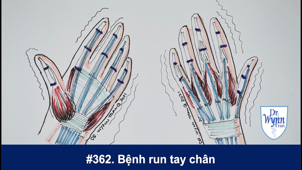 #362. Bệnh run tay chân và cách chữa