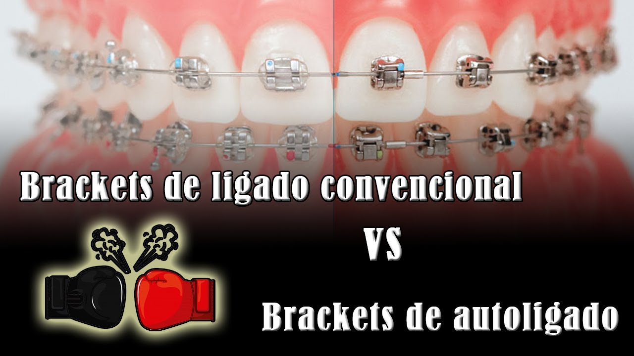 Brackets de ligado convencional VS brackets de autoligado
