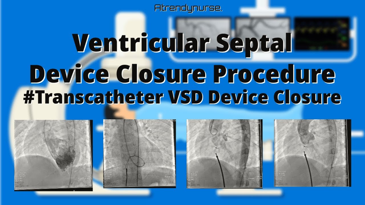 #VSD #VSD Device Closure #Transcatheter VSD Device Closure