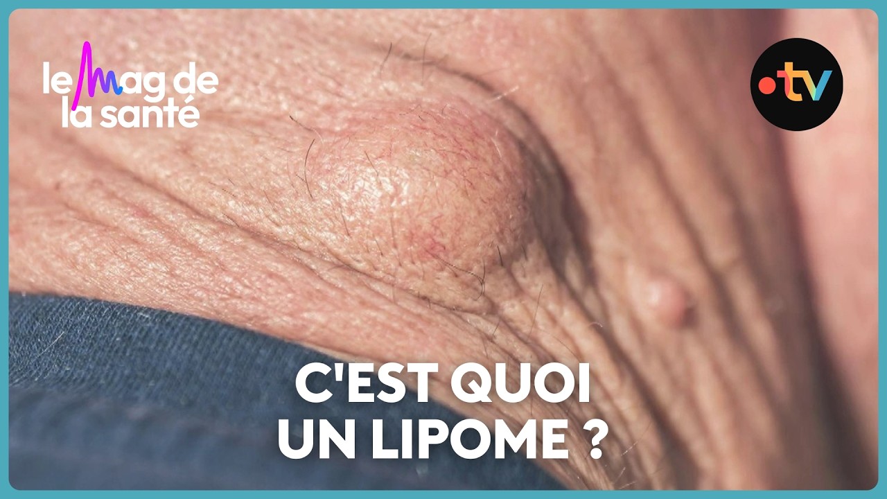 Boules de graisse sous la peau : comment les retirer ?