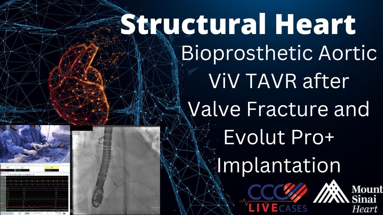 Bioprosthetic Aortic ViV TAVR after Valve Fracture and Evolut Pro+ Implantation