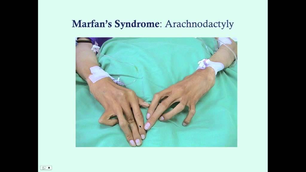 Marfan's Syndrome - CRASH! Medical Review Series