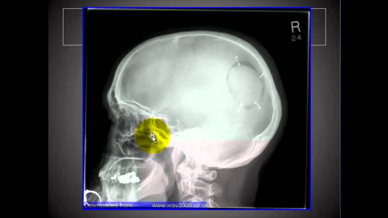 Lateral Skull and Sinuses.mp4