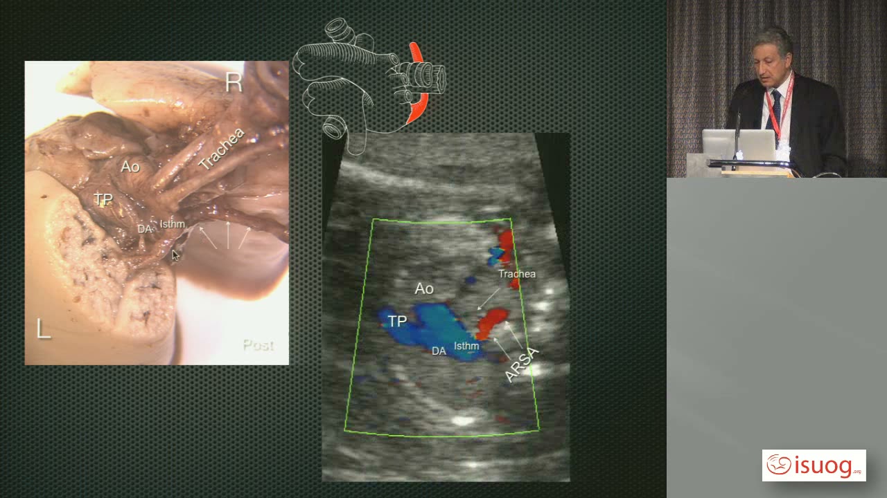 aberrent right subclavian artery