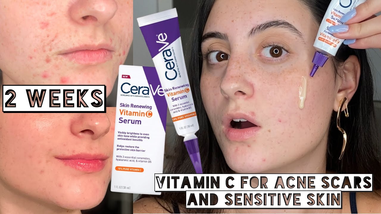 TESTING THE CERAVE VITAMIN C SERUM ON MY ACNE SCARS FOR 2 WEEKS | Dry, Sensitive, Acne Prone Skin