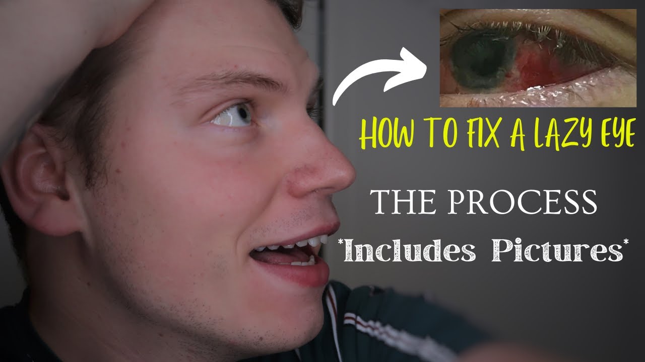 How To Fix A Lazy Eye | Strabismus Surgery | START to FINISH  (Including Pictures) Lazy Eye Surgery