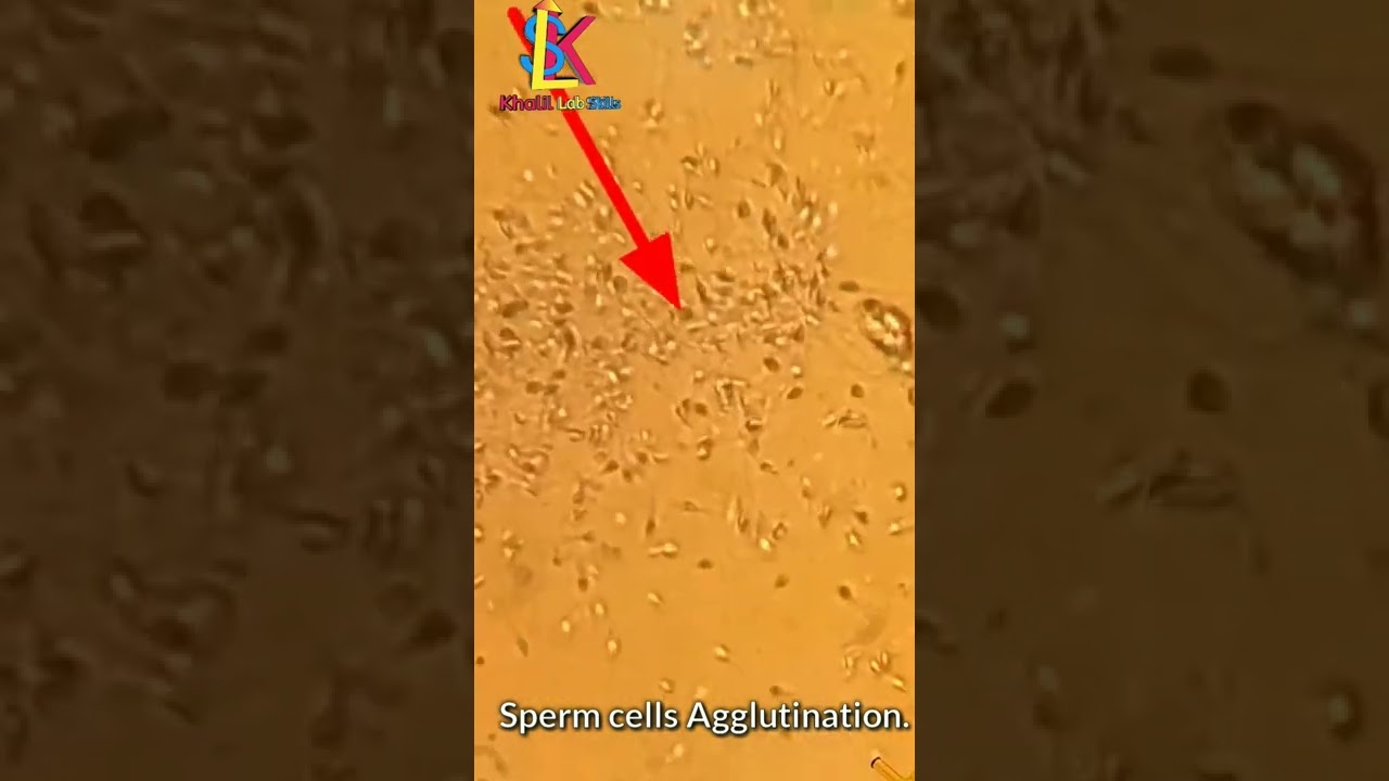 sperm cells agglutination under microscope.