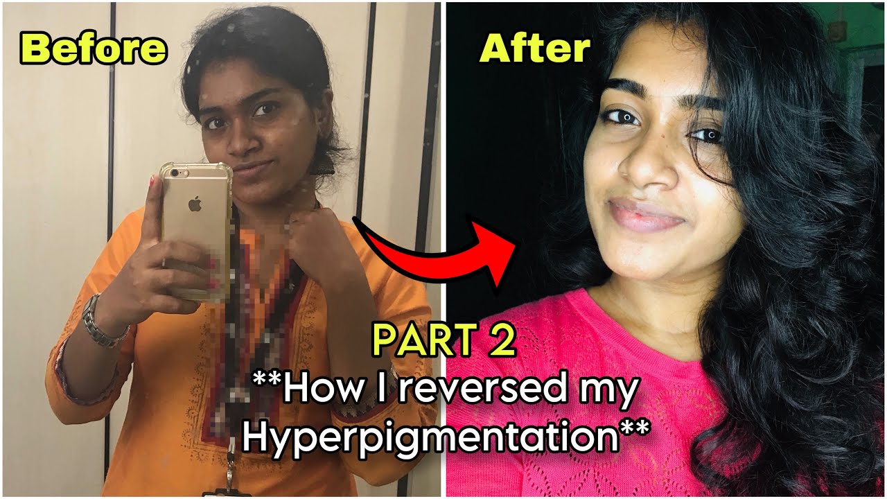 *With Detailed Product Usage Explanation* How I Reversed My Hyperpigmentation PART 2