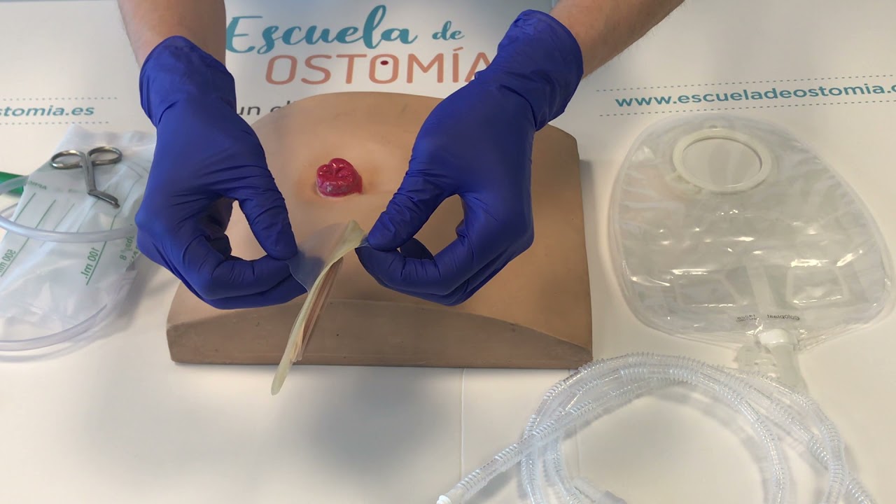 Cambio de disco de urostomía