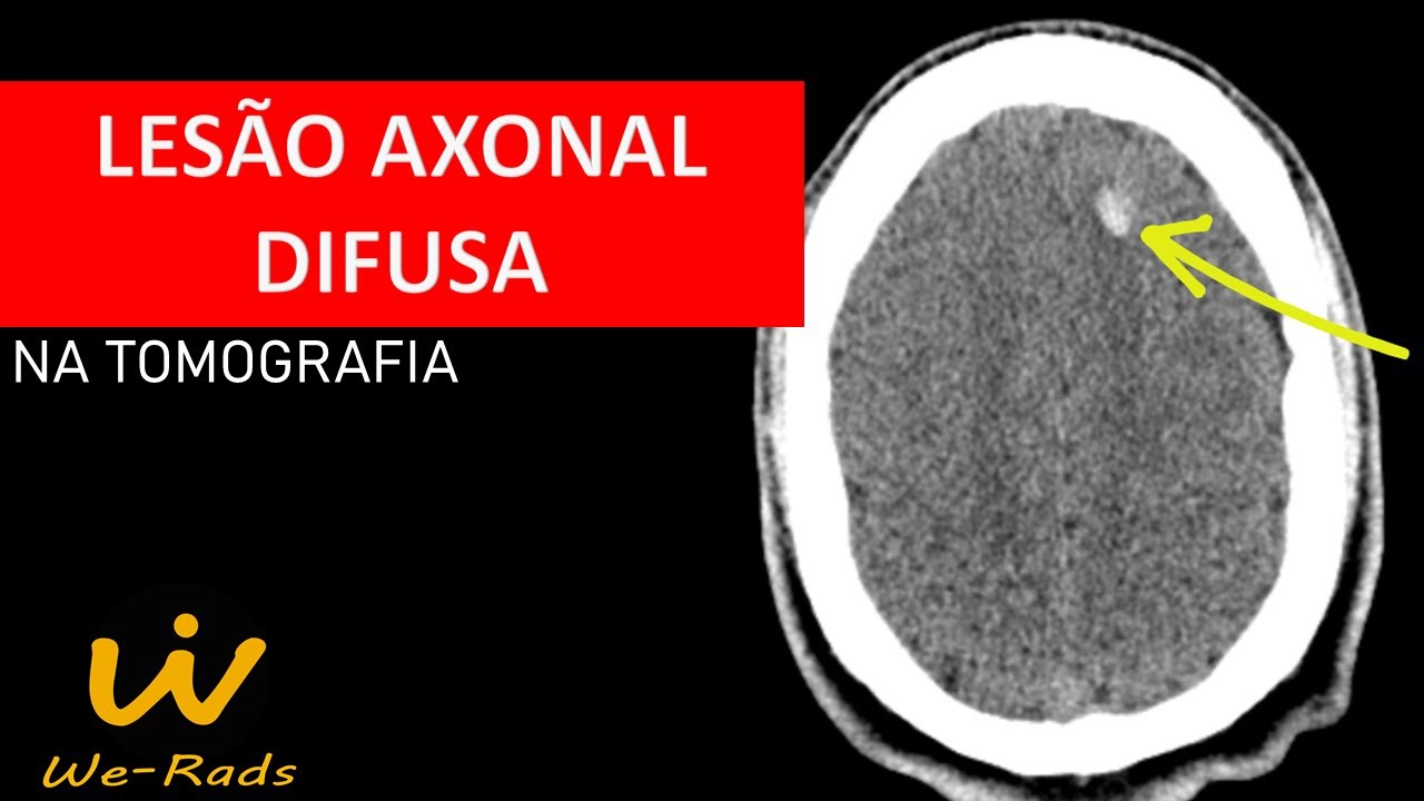 Lesão Axonal Difusa (LAD) na Tomografia Computadorizada (TC) de  Crânio