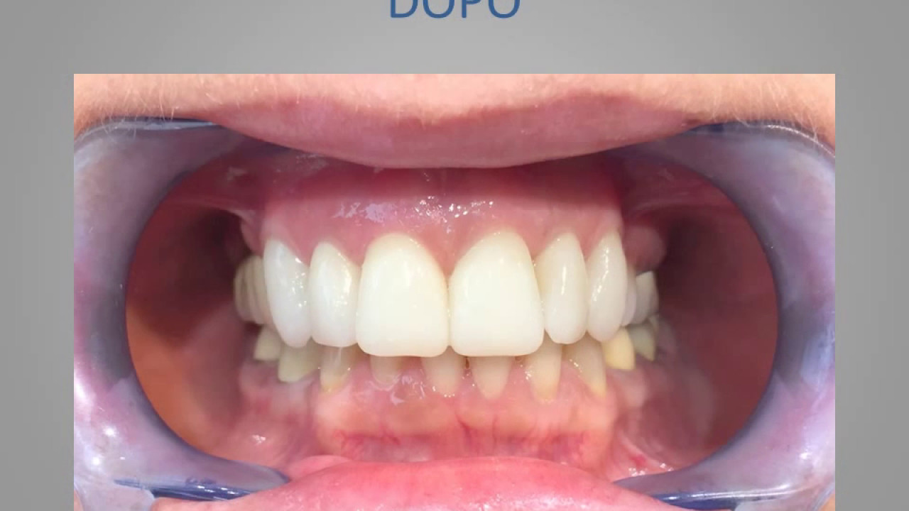 Faccette dentali prima e dopo, Estetica dentale, Faccette dentali & Lumineers