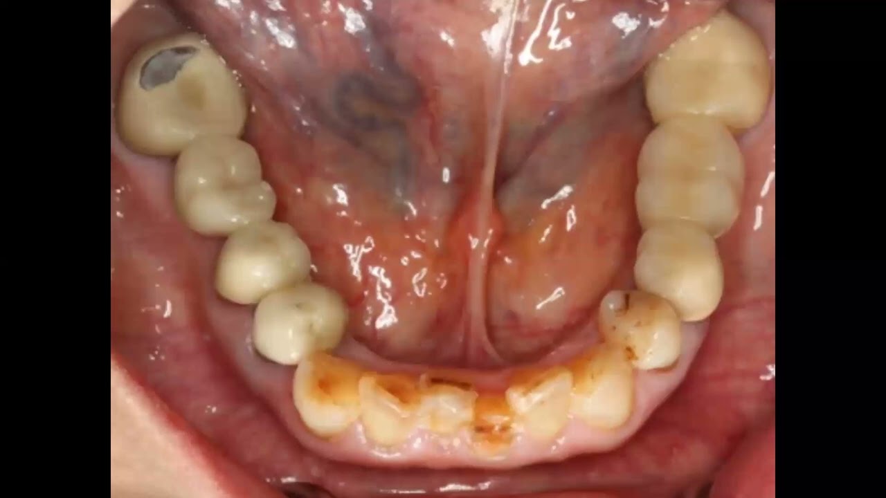 CB3 CB Occlusion 1 2