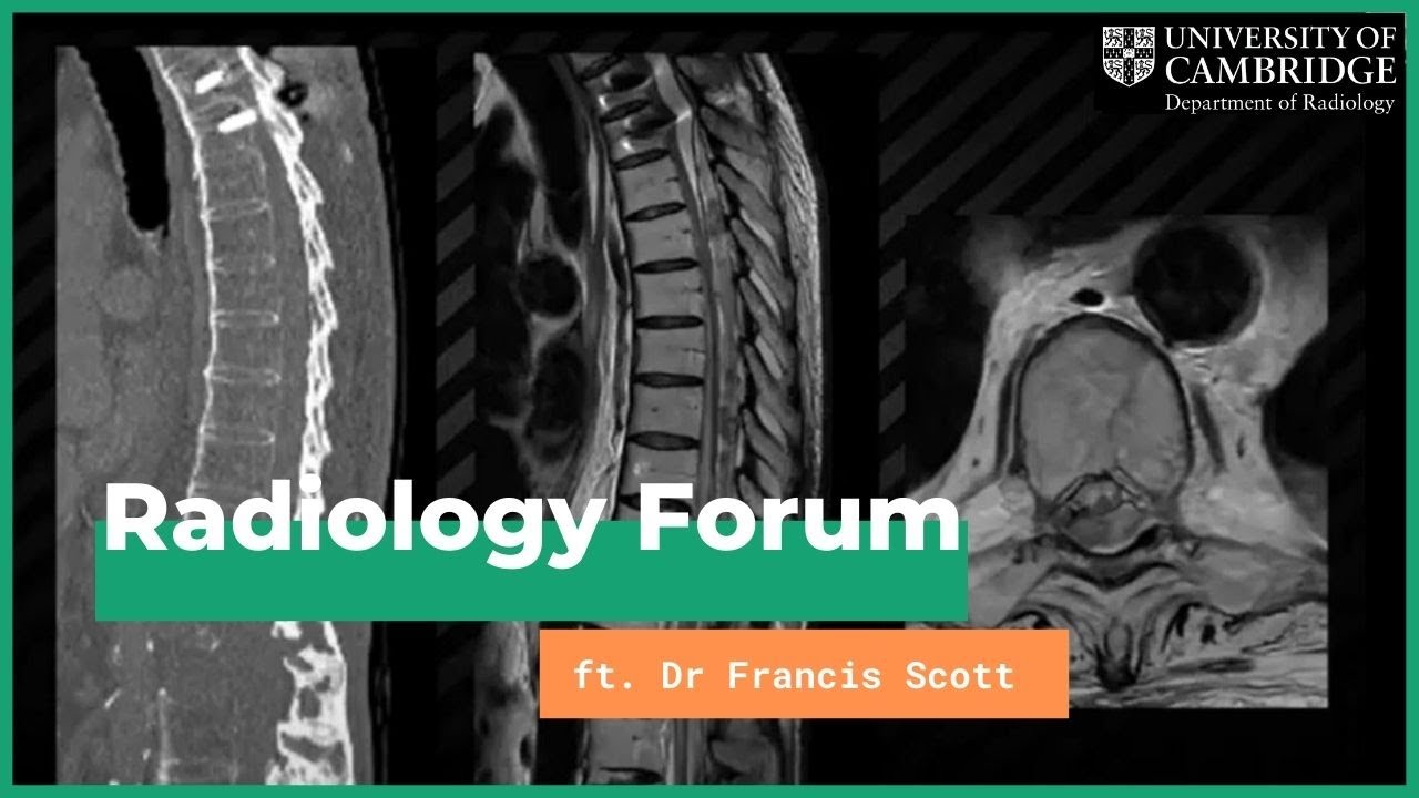 'Thoracolumbar Spine Trauma - Three Columns and Beyond' by Dr Francis Scott