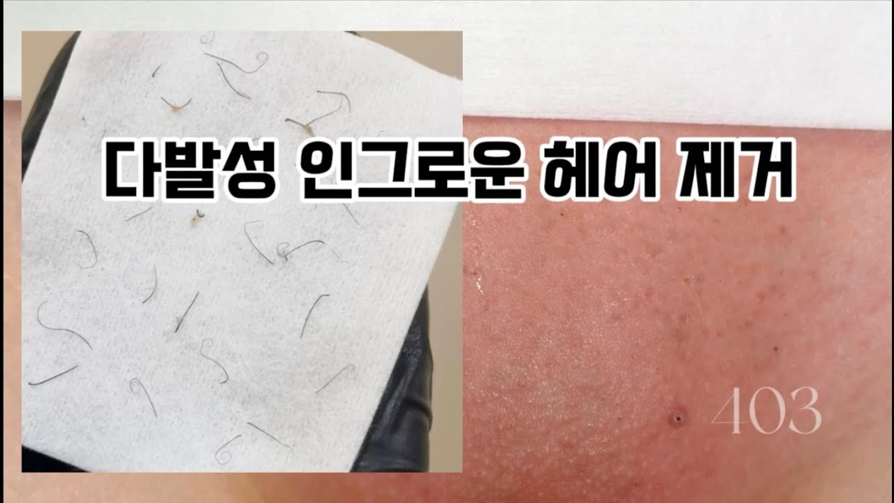 다발성 인그로운 헤어 제거 왁싱 후 생긴 부작용