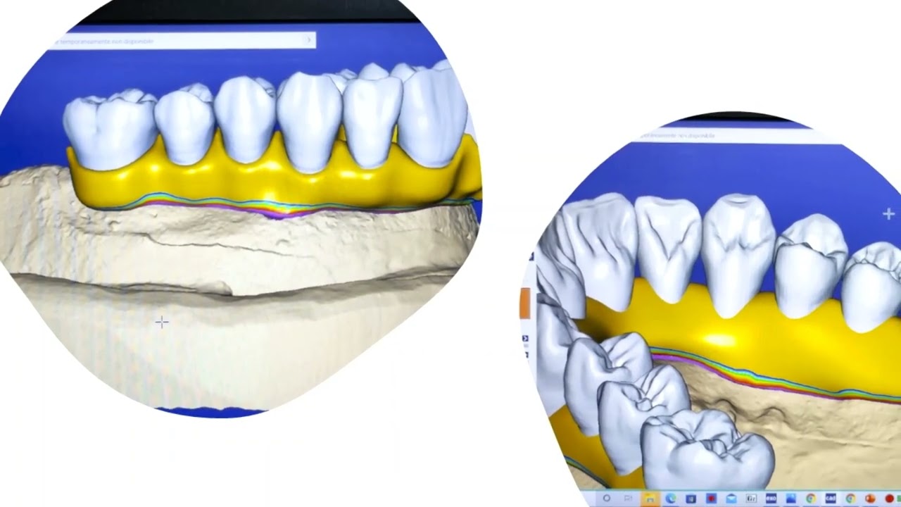 Toronto Implantari....design dental cad