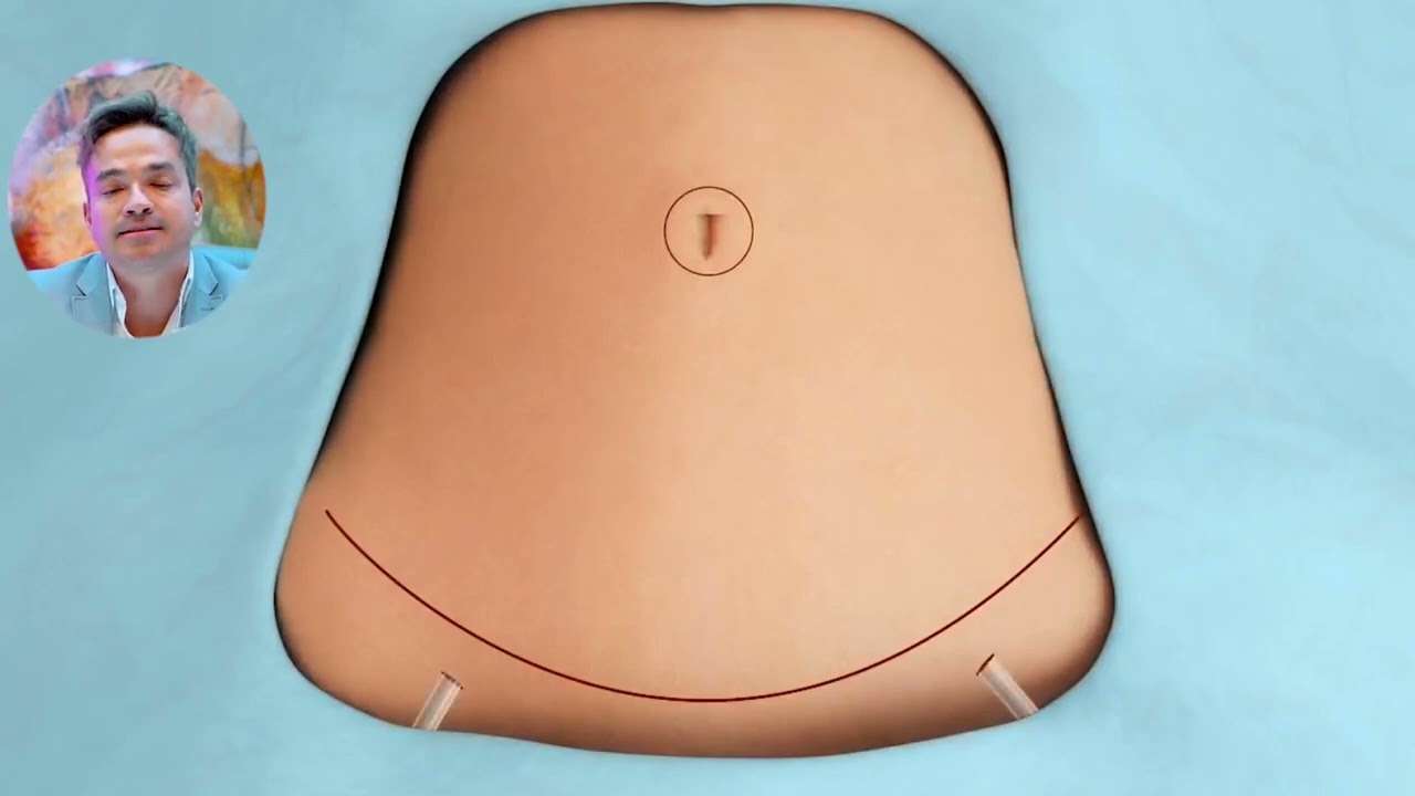 CICATRIZ IMPERCEPTÍVEL DA ABDOMINOPLASTIA