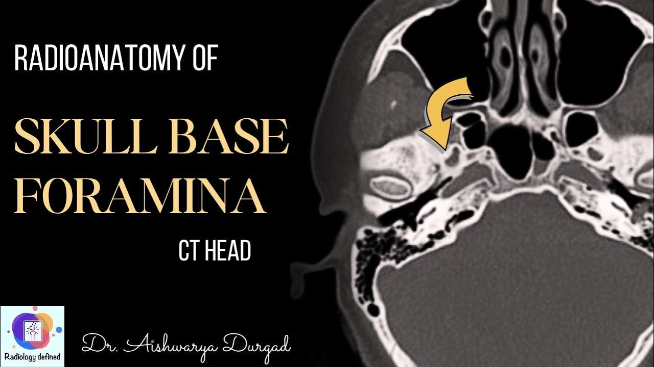 SKULL BASE FORAMINA on CT - Radiology defined. Video based discussion.