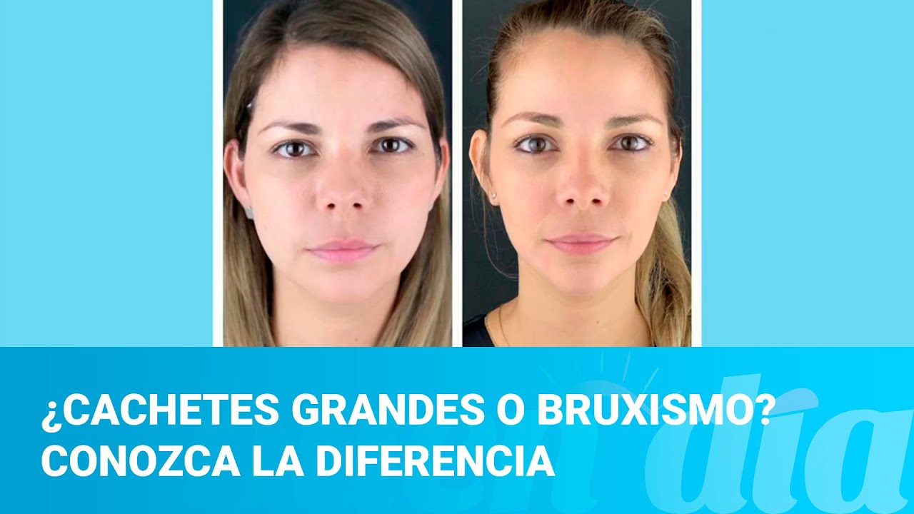 ¿Cachetes grandes o bruxismo? Conozca la diferencia