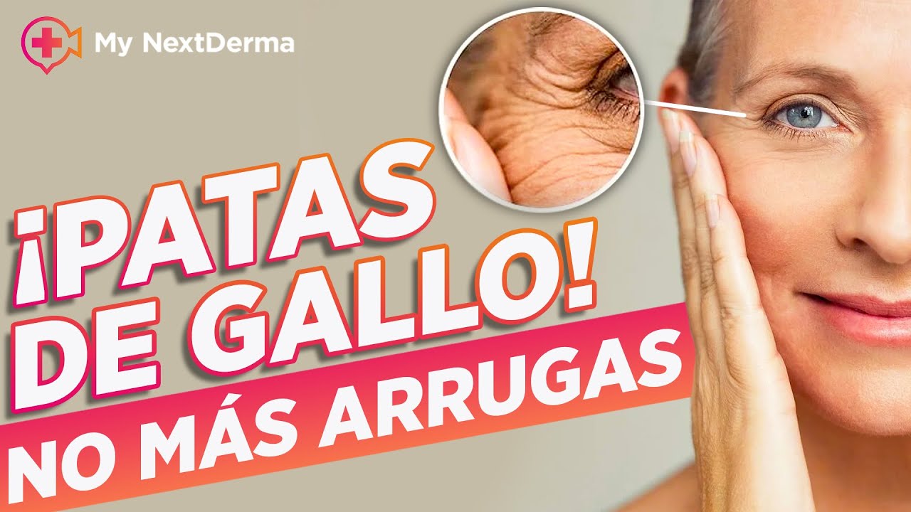 ¿PATAS DE GALLO? ¡TENGO TU Solución INMEDIATA!