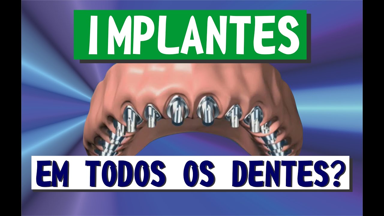 Ep.  28 - posso fazer implante de todos os dentes?