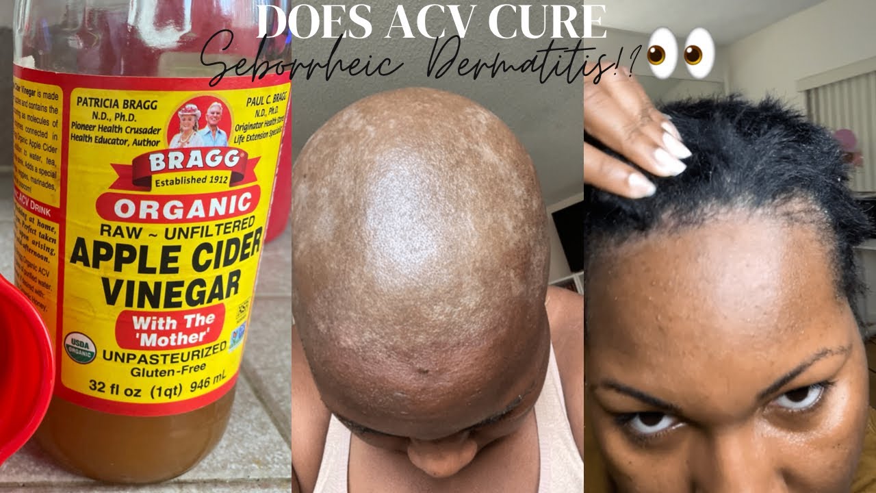 Treating My Seborrheic Dermatitis with ACV RINSE Remedy 🙆🏾😫👀😅