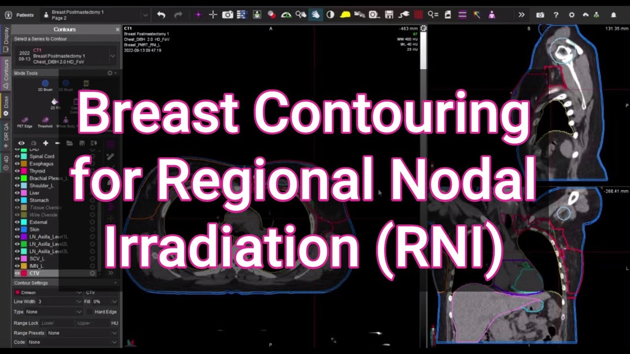 Breast Contouring Regional Nodes... a Walkthrough