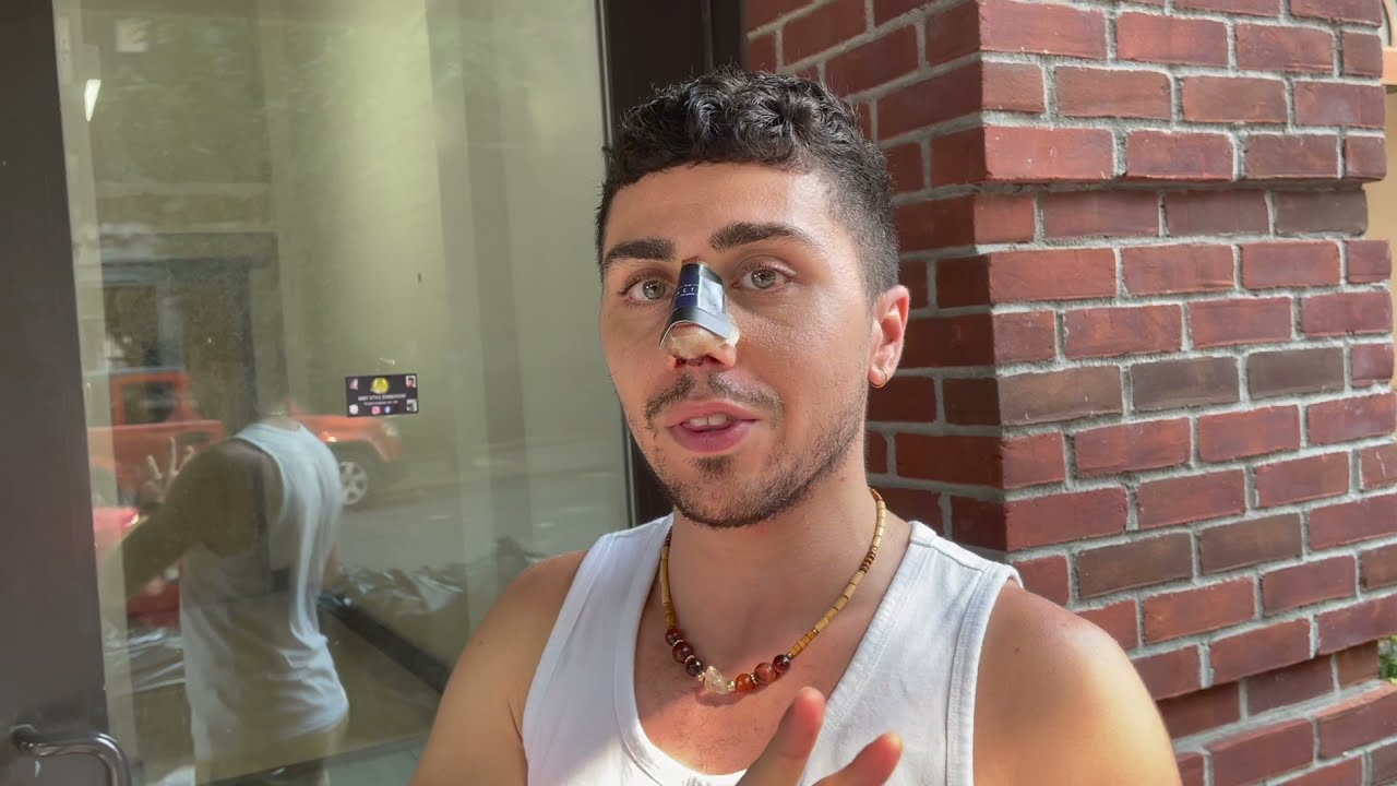 Male Goes to Istanbul, Turkey to Get a Rhinoplasty (Part 1)