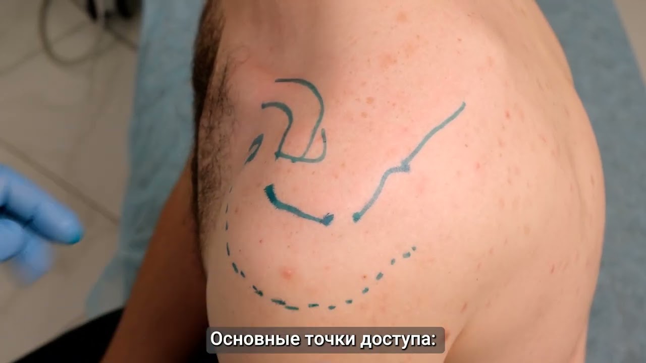 Хронотрон. Техника внутрисуставной инъекции в плечевой сустав. Задний доступ.